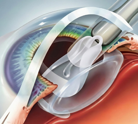 Refractive Lens Exchange (RLE):